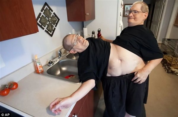 腹部相连只能轮流睡觉：世界最长寿男性连体双胞胎 68岁同时去世-第3张图片