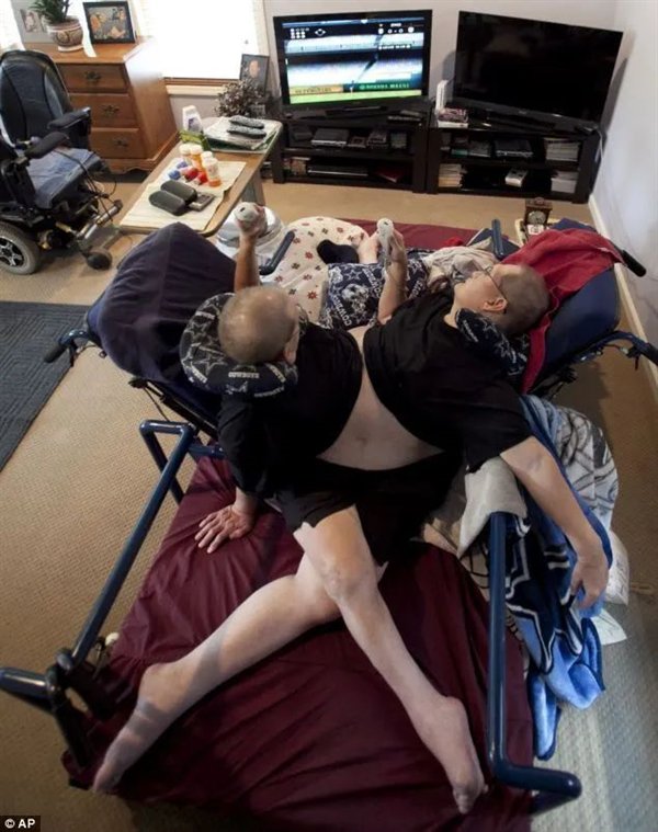 腹部相连只能轮流睡觉：世界最长寿男性连体双胞胎 68岁同时去世-第4张图片