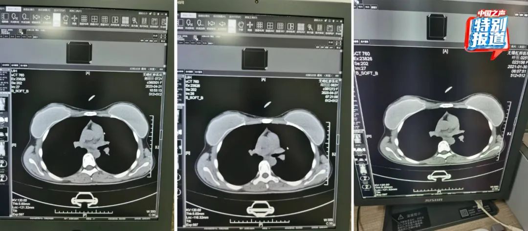 一张CT片子套多个病历？无锡虹桥医院涉嫌骗保，医生实名举报！-第5张图片